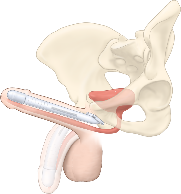 ZSI 100 FTM bükülebilir penil protezin anatomik yerleşim illüstrasyonu: neofallus içine yerleştirilmiş tek gövdeli semi-rijit silikon implant ve pubik kemiğe sabitlenen proksimal plaka