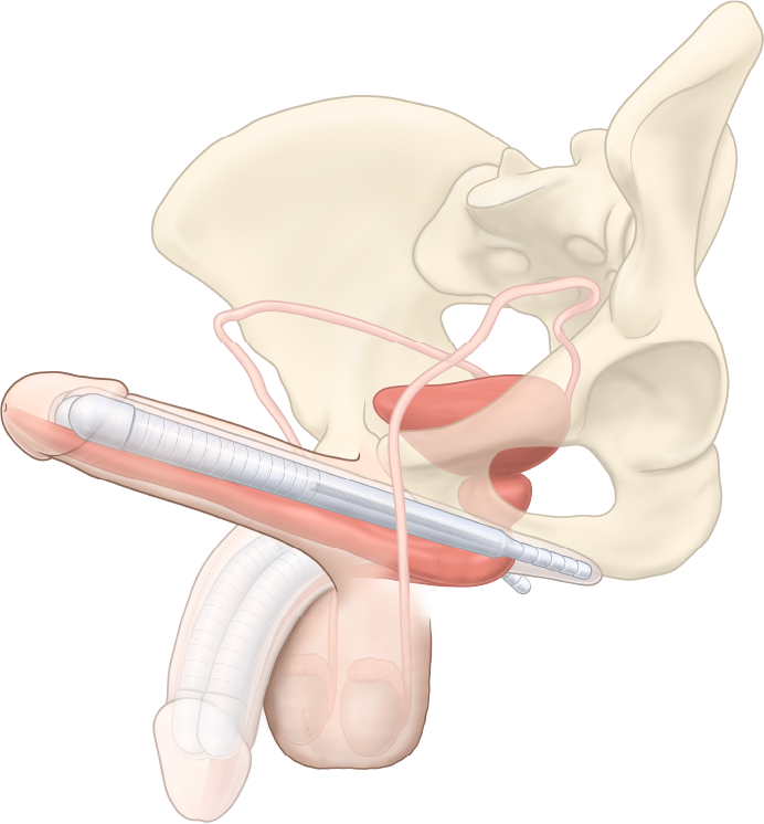 Anatomical placement illustration of the ZSI 100 malleable penile implant: two semi-rigid silicone cylinders inserted into the corpora cavernosa