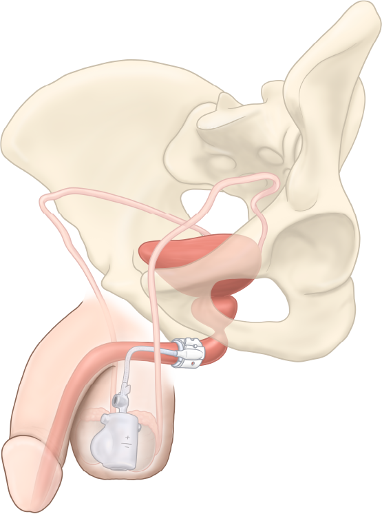 ZSI 375 PF yapay üriner sfinkterin anatomik yerleşim illüstrasyonu: üretra çevresindeki şişirilebilir kaf ve skrotuma yerleştirilen basınç düzenleyici balonlu pompa ünitesi; pelvik bölgede bileşen bulunmaz